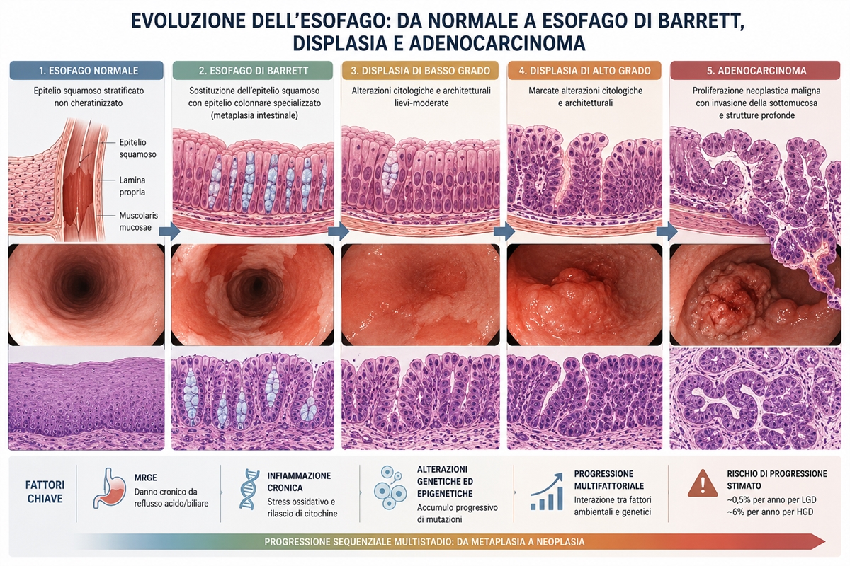 Dall'esofago normale all'adenocarcinoma: la sequenza metaplasia-displasia-cancro